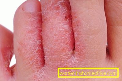 Gljivice stopala: simptomi bolesti