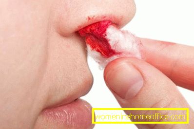 Kako zaustaviti krvarenje iz nosa?
